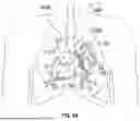 Fig. 38 - METHODS AND SYSTEMS FOR TREATING PULMONARY DISEASE