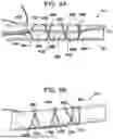 Fig. 11 - SYSTEMS AND METHODS FOR LIGAMENT GRAFT PREPARATION