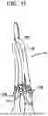 Fig. 24 - SYSTEMS AND METHODS FOR LIGAMENT GRAFT PREPARATION