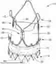 Fig. 01 - REPLACEMENT HEART VALVE IMPLANT