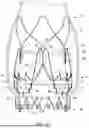 Fig. 13 - REPLACEMENT HEART VALVE IMPLANT