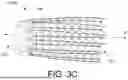 Fig. 07 - PROSTHETIC VALVES AND OVAL STENTS FOR FLOW BALANCING