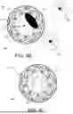 Fig. 09 - PROSTHETIC VALVES AND OVAL STENTS FOR FLOW BALANCING