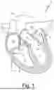 Fig. 02 - ANTENNAE FOR STENT AND HEART VALVES