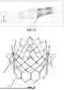 Fig. 13 - SYSTEMS, DEVICES, AND METHODS FOR TREATING HEART VALVES