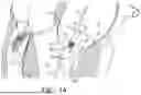 Fig. 02 - ATRIOVENTRICULAR VALVE REPAIR