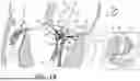 Fig. 03 - ATRIOVENTRICULAR VALVE REPAIR