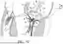 Fig. 04 - ATRIOVENTRICULAR VALVE REPAIR