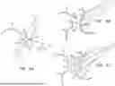 Fig. 10 - ATRIOVENTRICULAR VALVE REPAIR