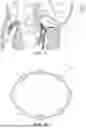 Fig. 13 - ATRIOVENTRICULAR VALVE REPAIR