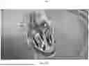 Fig. 31 - APPARATUS AND METHODS FOR TREATING A DEFECTIVE CARDIAC VALVE