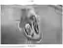 Fig. 33 - APPARATUS AND METHODS FOR TREATING A DEFECTIVE CARDIAC VALVE