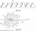 Fig. 08 - METHODS AND DEVICES FOR VENTRICULAR RESHAPING AND HEART VALVE RESHAPING