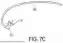 Fig. 14 - METHODS AND DEVICES FOR VENTRICULAR RESHAPING AND HEART VALVE RESHAPING
