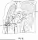 Fig. 19 - METHODS AND DEVICES FOR VENTRICULAR RESHAPING AND HEART VALVE RESHAPING