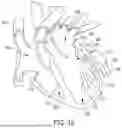 Fig. 21 - METHODS AND DEVICES FOR VENTRICULAR RESHAPING AND HEART VALVE RESHAPING