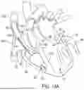 Fig. 24 - METHODS AND DEVICES FOR VENTRICULAR RESHAPING AND HEART VALVE RESHAPING