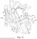 Fig. 25 - METHODS AND DEVICES FOR VENTRICULAR RESHAPING AND HEART VALVE RESHAPING