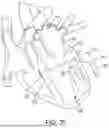 Fig. 32 - METHODS AND DEVICES FOR VENTRICULAR RESHAPING AND HEART VALVE RESHAPING