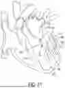 Fig. 36 - METHODS AND DEVICES FOR VENTRICULAR RESHAPING AND HEART VALVE RESHAPING
