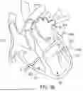 Fig. 40 - METHODS AND DEVICES FOR VENTRICULAR RESHAPING AND HEART VALVE RESHAPING