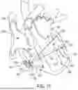 Fig. 41 - METHODS AND DEVICES FOR VENTRICULAR RESHAPING AND HEART VALVE RESHAPING