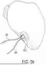 Fig. 42 - METHODS AND DEVICES FOR VENTRICULAR RESHAPING AND HEART VALVE RESHAPING