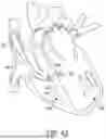 Fig. 44 - METHODS AND DEVICES FOR VENTRICULAR RESHAPING AND HEART VALVE RESHAPING