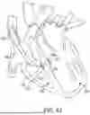 Fig. 45 - METHODS AND DEVICES FOR VENTRICULAR RESHAPING AND HEART VALVE RESHAPING