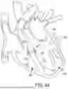 Fig. 46 - METHODS AND DEVICES FOR VENTRICULAR RESHAPING AND HEART VALVE RESHAPING