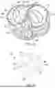 Fig. 47 - METHODS AND DEVICES FOR VENTRICULAR RESHAPING AND HEART VALVE RESHAPING
