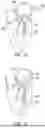 Fig. 64 - METHODS AND DEVICES FOR VENTRICULAR RESHAPING AND HEART VALVE RESHAPING