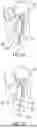 Fig. 67 - METHODS AND DEVICES FOR VENTRICULAR RESHAPING AND HEART VALVE RESHAPING