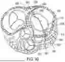 Fig. 70 - METHODS AND DEVICES FOR VENTRICULAR RESHAPING AND HEART VALVE RESHAPING