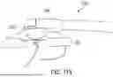 Fig. 82 - METHODS AND DEVICES FOR VENTRICULAR RESHAPING AND HEART VALVE RESHAPING