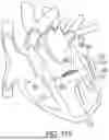 Fig. 86 - METHODS AND DEVICES FOR VENTRICULAR RESHAPING AND HEART VALVE RESHAPING