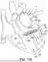 Fig. 87 - METHODS AND DEVICES FOR VENTRICULAR RESHAPING AND HEART VALVE RESHAPING