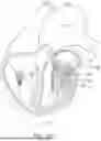 Fig. 91 - METHODS AND DEVICES FOR VENTRICULAR RESHAPING AND HEART VALVE RESHAPING