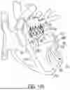 Fig. 92 - METHODS AND DEVICES FOR VENTRICULAR RESHAPING AND HEART VALVE RESHAPING