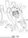 Fig. 93 - METHODS AND DEVICES FOR VENTRICULAR RESHAPING AND HEART VALVE RESHAPING