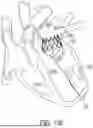 Fig. 94 - METHODS AND DEVICES FOR VENTRICULAR RESHAPING AND HEART VALVE RESHAPING