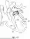 Fig. 95 - METHODS AND DEVICES FOR VENTRICULAR RESHAPING AND HEART VALVE RESHAPING