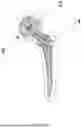 Fig. 04 - PREPARATION METHOD OF A HIP JOINT BONE CEMENT PLACEHOLDER