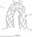 Fig. 06 - PSEUDO HOOKED WIRE STENT