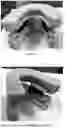 Fig. 05 - ORAL DEVICE TO INHIBIT MASTICATION AND INGESTION OF SOLID FOOD