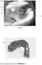 Fig. 07 - ORAL DEVICE TO INHIBIT MASTICATION AND INGESTION OF SOLID FOOD