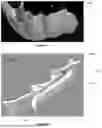 Fig. 08 - ORAL DEVICE TO INHIBIT MASTICATION AND INGESTION OF SOLID FOOD