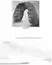 Fig. 13 - ORAL DEVICE TO INHIBIT MASTICATION AND INGESTION OF SOLID FOOD