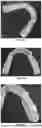 Fig. 16 - ORAL DEVICE TO INHIBIT MASTICATION AND INGESTION OF SOLID FOOD
