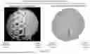 Fig. 15 - WOUND DRESSING WITH SEMI-RIGID SUPPORT TO INCREASE DISRUPTION USING PERFORATED DRESSING AND NEGATIVE PRESSURE WOUND THERAPY
